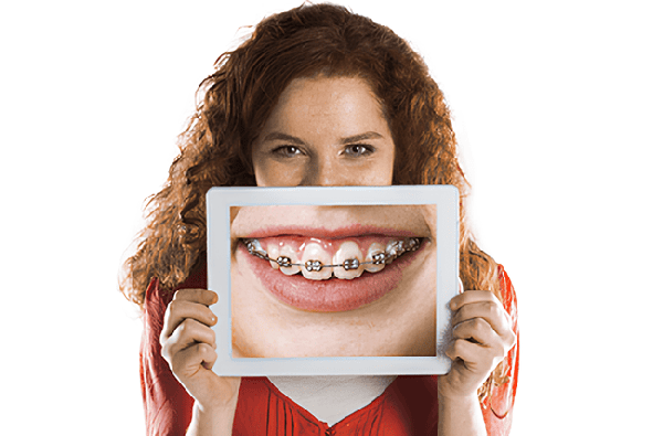 Преимущества брекет-систем в стоматологической клинике