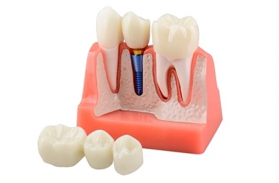 Как за один день можно получить коронку или винир благодаря CAD/CAM