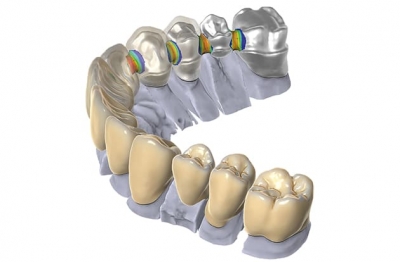 CAD/CAM против традиционных методов. В чём разница?