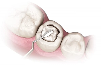 Пломбирование зубов: Современный метод восстановления, объединяющий здоровье и внешний вид