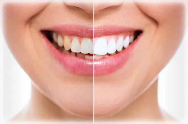 Переваги професійного відбілювання зубів в стоматологічній клініці.