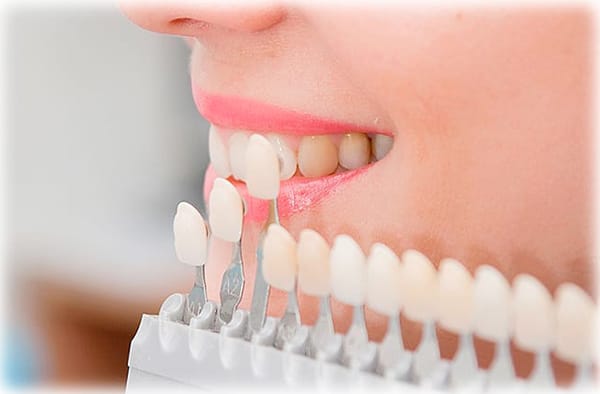 Вініри: Секрет бездоганної посмішки в стоматологічній клініці "Майстерня Посмішки"